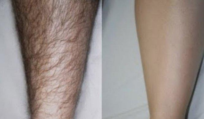 Mencukur Bulu Kaki: Manfaat, Risiko, dan Fakta yang Perlu Diketahui