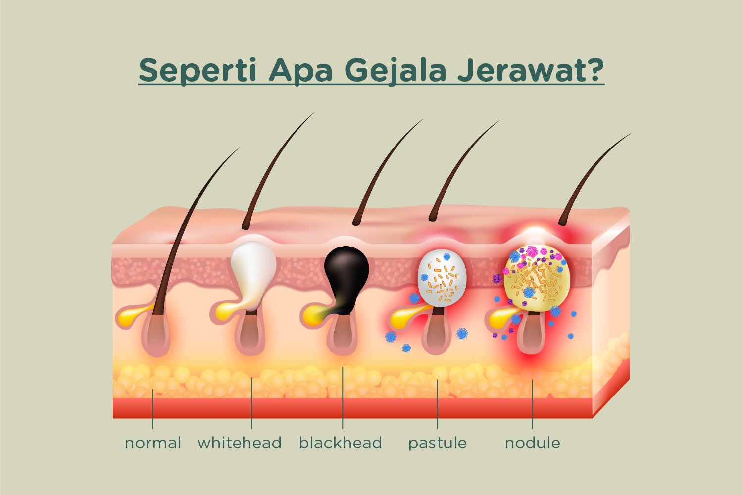Jerawat Tak Muncul Tiba-Tiba: Ini Penyebab Utama yang Jarang Disadari