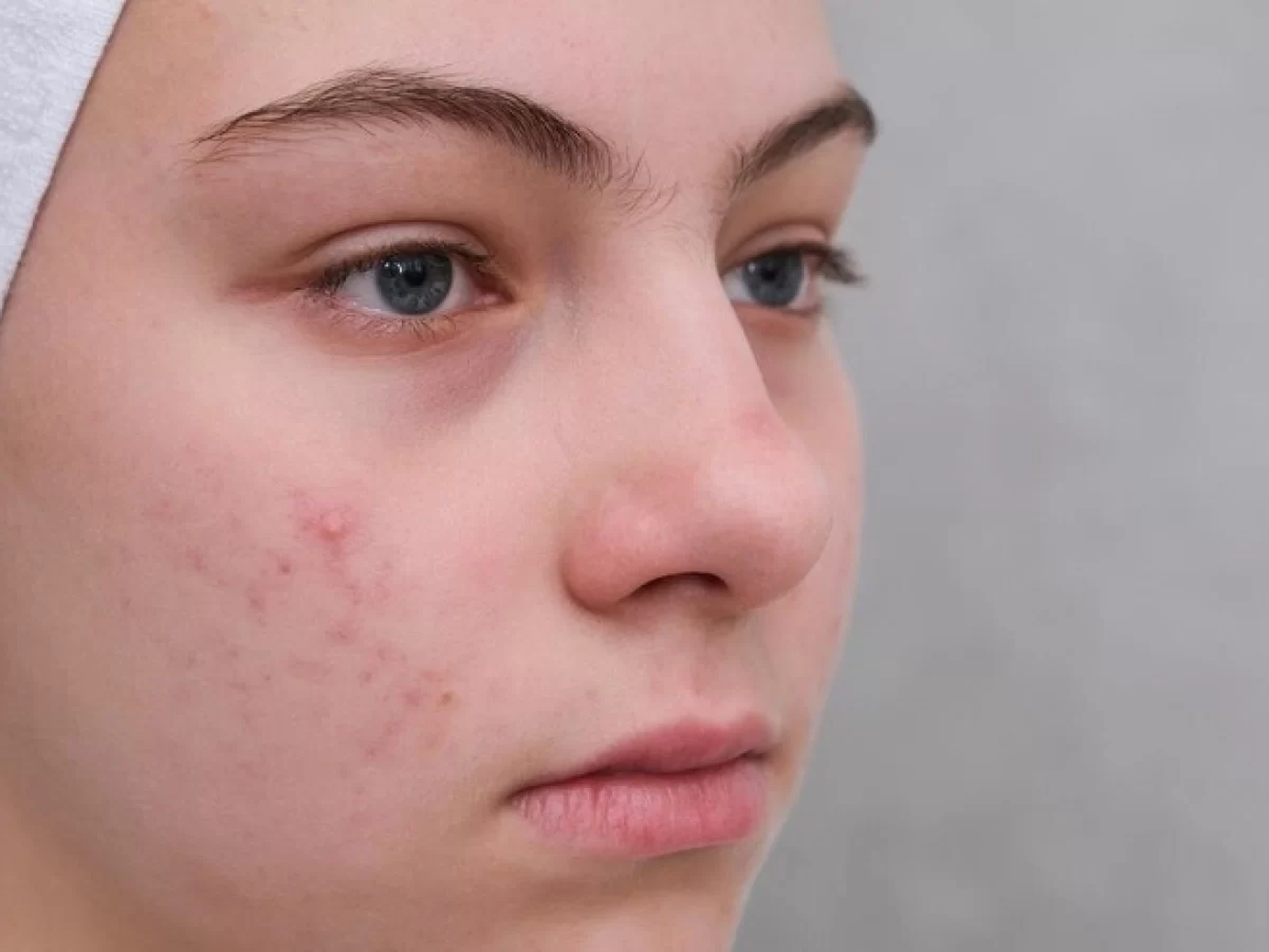 Jerawat Selalu Muncul Saat Menstruasi? Kenali Peran Hormon dan Apakah Ini Akan Terus Terjadi