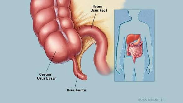 Setelah Operasi Usus Buntu, Apa yang Sebenarnya Terjadi pada Tubuh Kita?