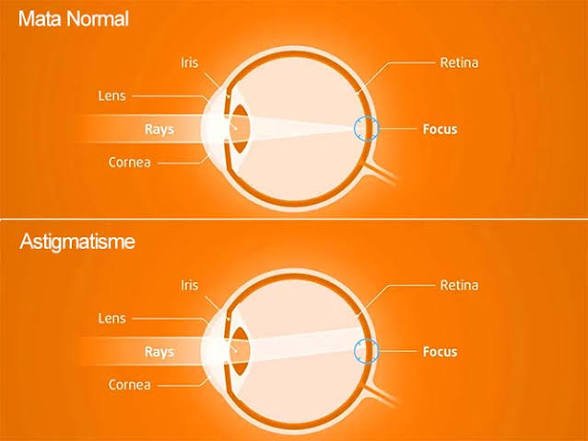 Penglihatan Terasa Berbayang? Ini Penyebab Mata Silinder yang Sering Tidak Disadari
