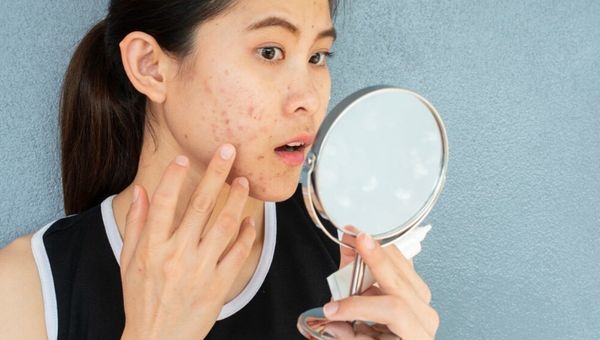 Apakah Makan Kacang Bikin Jerawatan? Ini Fakta dan Cara Aman Mengonsumsinya